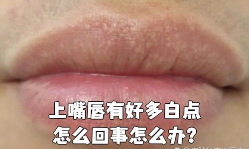 银屑甲治疗期间会不会大爆发网- 银屑甲可以自愈吗知识,分享银屑甲会单独发生吗