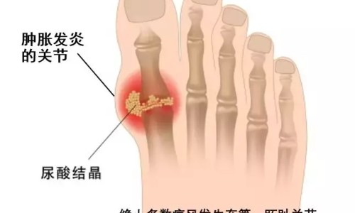 银屑病甲可以治愈吗-银屑甲治疗期间会不会大爆发网- 银屑甲可以自愈吗知识,分享银屑甲会单独发生吗